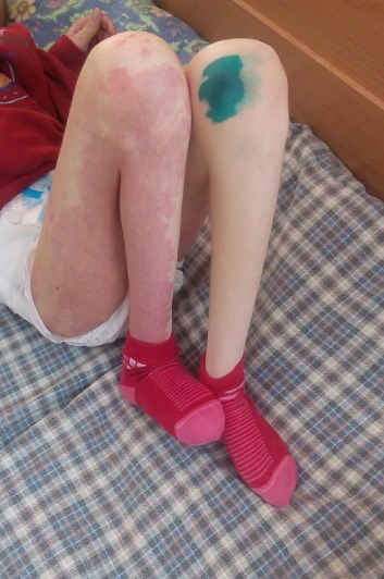 ноги пациента  с  синдром штурге  вебера